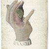 Pl. No. 1 of Dr. Jones’ papers : Hospital gangrene : Case of W.J. Black. No. VII / Painted from nature by Joseph Jones. Surgeon PACS
