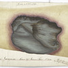 Pl. No. 2 of Dr. Jones’ papers : Hospital gangrene : Case of Thomas Paine. No. VIII / Painted from nature by Joseph Jones. Surgeon PACS