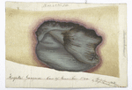 Pl. No. 2 of Dr. Jones’ papers : Hospital gangrene : Case of Thomas Paine. No. VIII / Painted from nature by Joseph Jones. Surgeon PACS