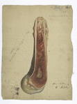 Plate 1. Dr Hamilton’s case of osteo-myelitis after gunshot fracture of femur. Lower fragment. Case 10. David Suffern. / After Nature by R. Köhler