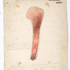 Plate 5. Dr. Hamilton’s case of osteo-myelitis, following amputation, made for traumatic disease of elbow-joint. Case 14. Wm [Dargen]. / Drawn from nature by Aug H. Heyer Jan’y 20th 1866