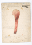 Plate 5. Dr. Hamilton’s case of osteo-myelitis, following amputation, made for traumatic disease of elbow-joint. Case 14. Wm [Dargen]. / Drawn from nature by Aug H. Heyer Jan’y 20th 1866