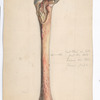 Plate 11. Dr. Van Buren’s case of acute osteo-myelitis, in a girl eleven years old. Outer surface of specimen. Successful amputation at [knee]-joint. Case 49