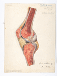Plate 12. Dr. Gouley’s case of chronic, [scrophulous] osteo-myelitis, following [white-swelling] of [knee]-joint. Amputation of thigh. [Resection]  recovery. Case 51. / from nature by R. Köhler