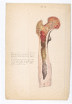 Plate 13. [John Schmidt (…) 28. Amputation at hip joint. Sept. 1866. By Dr. Hamilton. / from nature by R. Köhler.]