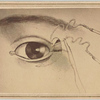 Illustration of suture near eyelid]