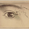 [Photograph of illustration of suture near eyelid] New York : Hamilton, photographer, 1865