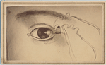 Illustration of suture near eyelid