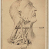 Photograph of illustration showing male head in right profile with exposed muscles and veins of neck, with inserted metal probe