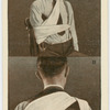 Fractured collar-bone and shoulder-blade.