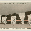 Fractured leg below the knew.