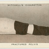 Fractured pelvis.