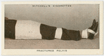 Fractured pelvis.