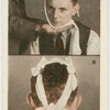 Fractured jaw.