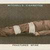 Fractured spine.