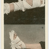 Crushed hand and foot.