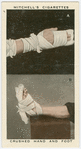 Crushed hand and foot.