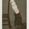 Varicose veins.