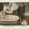Convulsion in a child.