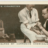 Burns and corrosive chemicals.