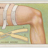 Strapping wound.