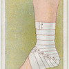 Roller bandage.