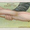 Compression of artery.