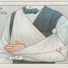 Fractured collar-bone.
