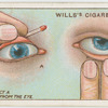 Foreign body in eye.