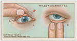 Foreign body in eye.