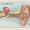 Foreign body in ear.