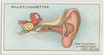 Foreign body in ear.