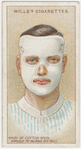 Burns on face.