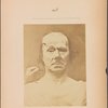 Fig. 7 : A study of the mechanism of action of the m. frontalis in an old man (see his photographic portrait, Fig. 3). On the right, a moderate degree of electrical excitation of m. frontalis; fundamental line (elevation and curvature of the eyebrow) and