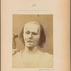 Fig. 9 : A study of m. frontalis in maximum contraction. On the right maximal excitation of  m. frontalis : Profound attention. On the left, a relaxed face.