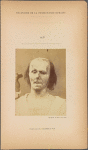 Fig. 9 : A study of m. frontalis in maximum contraction. On the right maximal excitation of  m. frontalis : Profound attention. On the left, a relaxed face.