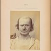 Fig. 12 : Showing, as does Fig. 13, a study of the contraction of and the expression produced by the superior part of m. orbicularis oculi (B, Figure 1), in a old man (also shown in Fig. 2, 7, 8, 9).