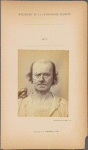 Fig. 12 : Showing, as does Fig. 13, a study of the contraction of and the expression produced by the superior part of m. orbicularis oculi (B, Figure 1), in a old man (also shown in Fig. 2, 7, 8, 9).