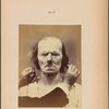 Fig. 13 : Stronger electrization of the superior part of m. orbicularis oculi, with slight lowering of the labial commissures : meditation, mental concentration.