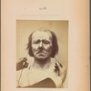 Fig. 20 : Electrical stimulation, to a moderate degree, of the m. corrugator supercilii : profound suffering, with resignation.