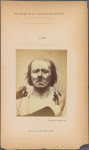 Fig. 20 : Electrical stimulation, to a moderate degree, of the m. corrugator supercilii : profound suffering, with resignation.