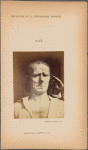 Fig. 22 : Beyond a certain degree of contraction, and in some condition, m. corrugator supercilii is no longer expressive.
