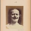 Fig. 32 : The same subject as in Fig. 30 and 31, showing the natural laughter really is constituted by the association of m. zygomaticus major and the inferior part of m. orbicularis oculi.