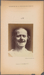 Fig. 32 : The same subject as in Fig. 30 and 31, showing the natural laughter really is constituted by the association of m. zygomaticus major and the inferior part of m. orbicularis oculi.