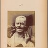 Fig. 34 : Showing, in the same subject, that the combination of the muscles of joy and pain, at certain degrees of contraction, will only produce a grimace. Strong electrical contractions of m. zygomaticus major and of m. corrugator supercilii : grimace.