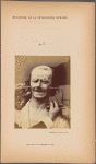 Fig. 34 : Showing, in the same subject, that the combination of the muscles of joy and pain, at certain degrees of contraction, will only produce a grimace. Strong electrical contractions of m. zygomaticus major and of m. corrugator supercilii : grimace.