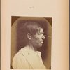 Fig. 41 : To demonstrate the movement of the alae of the same man�s nose by the transverse part of m. nasalis, and the morphology of this muscle when the nose is aquiline;