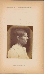 Fig. 41 : To demonstrate the movement of the alae of the same man�s nose by the transverse part of m. nasalis, and the morphology of this muscle when the nose is aquiline;