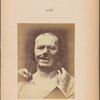 Fig. 53 : Showing, on one side, the expressive action of m. levator labii superioris alaeque nasi, combined with those of the palpebral part of m. orbicularis oculi, compared to the expression of m. zygomaticus major on the opposite side.