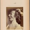 Fig. 57 : To study the combined maximal contraction of mm. frontalis and the muscles that lower the mandible. Voluntary maximal opening of the mouth and energetic electrical stimulation of mm. frontalis : astonishment, stupefaction, amazement.